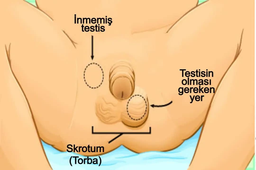 Yenidoğanlarda İnmemiş Testis Sorunu | Dr. Murat Gökhan Kınaş